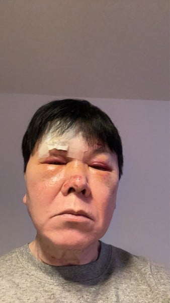 Yūji Mitsuya injured